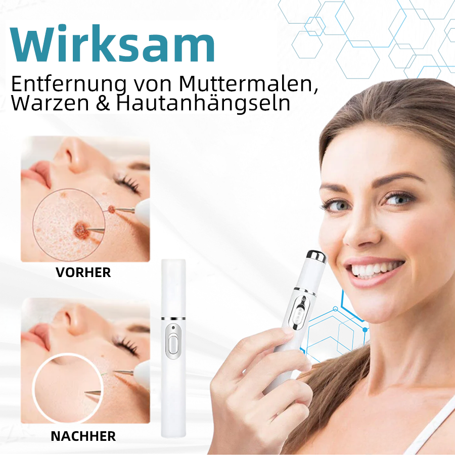 Hier beginnt dein neues Hautvertrauen🔔 𝗞𝗶𝗱𝘀𝗻𝗲𝗲𝗱® Nicht-invasive MoIie- und Warzenentfernung mit dem Laser-Stift 👨‍⚕️ Entwickelt von der Deutschen Dermatologischen Gesellschaft (DDG).