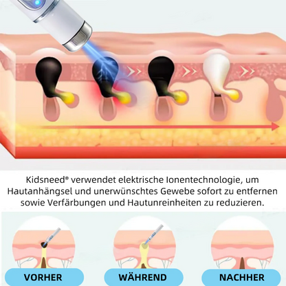 Hier beginnt dein neues Hautvertrauen🔔 𝗞𝗶𝗱𝘀𝗻𝗲𝗲𝗱® Nicht-invasive MoIie- und Warzenentfernung mit dem Laser-Stift 👨‍⚕️ Entwickelt von der Deutschen Dermatologischen Gesellschaft (DDG).