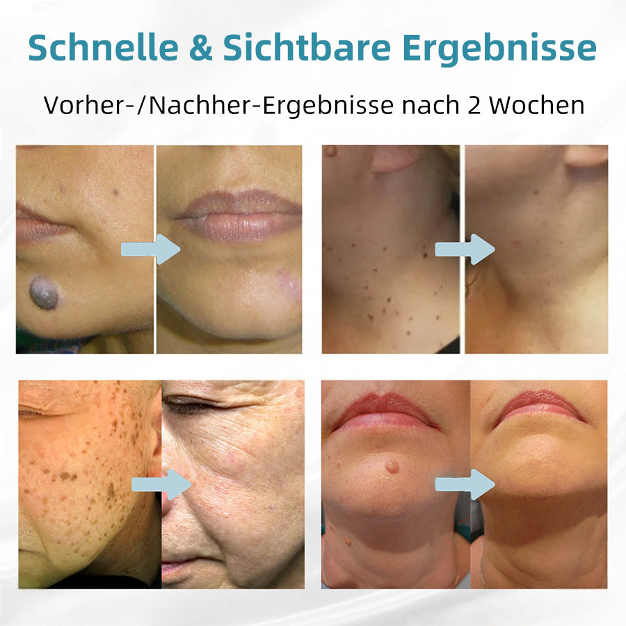 Hier beginnt dein neues Hautvertrauen🔔 𝗞𝗶𝗱𝘀𝗻𝗲𝗲𝗱® Nicht-invasive MoIie- und Warzenentfernung mit dem Laser-Stift 👨‍⚕️ Entwickelt von der Deutschen Dermatologischen Gesellschaft (DDG).