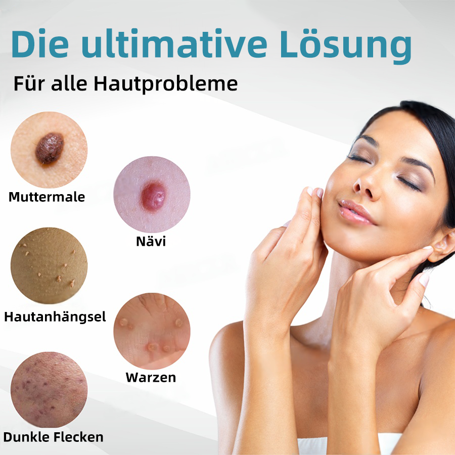 Hier beginnt dein neues Hautvertrauen🔔 𝗞𝗶𝗱𝘀𝗻𝗲𝗲𝗱® Nicht-invasive MoIie- und Warzenentfernung mit dem Laser-Stift 👨‍⚕️ Entwickelt von der Deutschen Dermatologischen Gesellschaft (DDG).