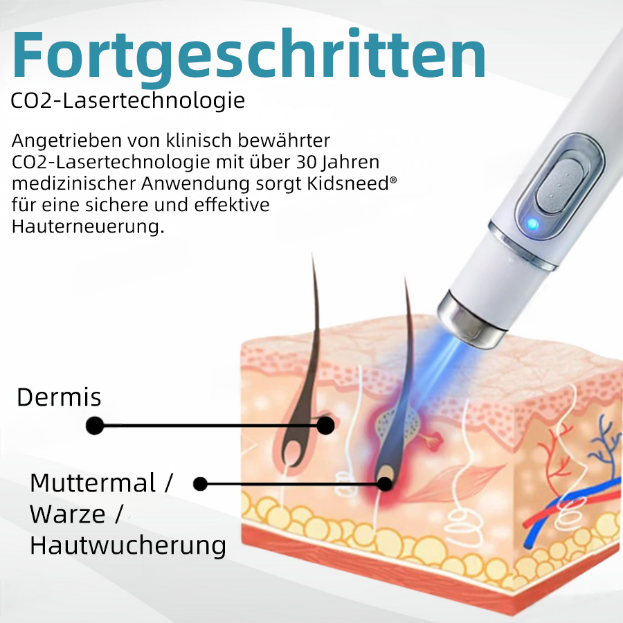 Hier beginnt dein neues Hautvertrauen🔔 𝗞𝗶𝗱𝘀𝗻𝗲𝗲𝗱® Nicht-invasive MoIie- und Warzenentfernung mit dem Laser-Stift 👨‍⚕️ Entwickelt von der Deutschen Dermatologischen Gesellschaft (DDG).