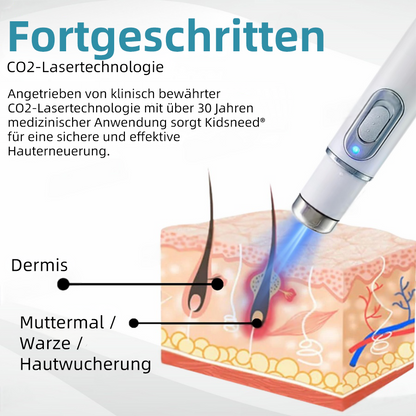 Hier beginnt dein neues Hautvertrauen🔔 𝗞𝗶𝗱𝘀𝗻𝗲𝗲𝗱® Nicht-invasive MoIie- und Warzenentfernung mit dem Laser-Stift 👨‍⚕️ Entwickelt von der Deutschen Dermatologischen Gesellschaft (DDG).