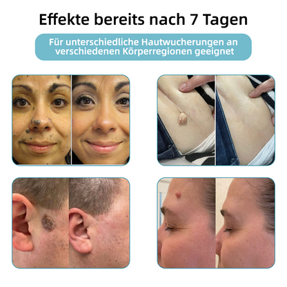 Hier beginnt dein neues Hautvertrauen🔔 𝗞𝗶𝗱𝘀𝗻𝗲𝗲𝗱® Nicht-invasive MoIie- und Warzenentfernung mit dem Laser-Stift 👨‍⚕️ Entwickelt von der Deutschen Dermatologischen Gesellschaft (DDG).