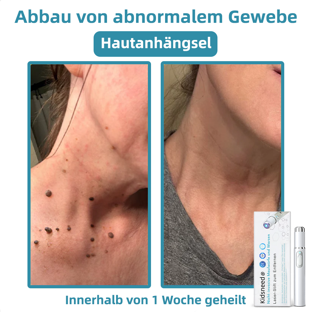 Hier beginnt dein neues Hautvertrauen🔔 𝗞𝗶𝗱𝘀𝗻𝗲𝗲𝗱® Nicht-invasive MoIie- und Warzenentfernung mit dem Laser-Stift 👨‍⚕️ Entwickelt von der Deutschen Dermatologischen Gesellschaft (DDG).