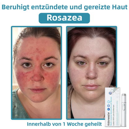 Hier beginnt dein neues Hautvertrauen🔔 𝗞𝗶𝗱𝘀𝗻𝗲𝗲𝗱® Nicht-invasive MoIie- und Warzenentfernung mit dem Laser-Stift 👨‍⚕️ Entwickelt von der Deutschen Dermatologischen Gesellschaft (DDG).