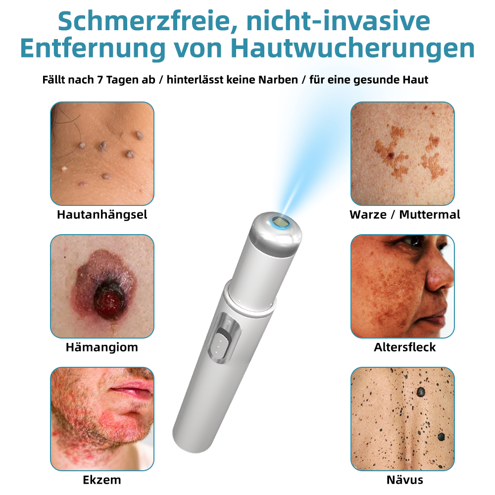 Hier beginnt dein neues Hautvertrauen🔔 𝗞𝗶𝗱𝘀𝗻𝗲𝗲𝗱® Nicht-invasive MoIie- und Warzenentfernung mit dem Laser-Stift 👨‍⚕️ Entwickelt von der Deutschen Dermatologischen Gesellschaft (DDG).