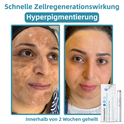 Hier beginnt dein neues Hautvertrauen🔔 𝗞𝗶𝗱𝘀𝗻𝗲𝗲𝗱® Nicht-invasive MoIie- und Warzenentfernung mit dem Laser-Stift 👨‍⚕️ Entwickelt von der Deutschen Dermatologischen Gesellschaft (DDG).