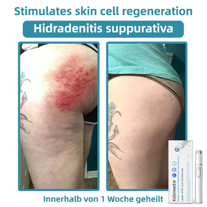 Hier beginnt dein neues Hautvertrauen🔔 𝗞𝗶𝗱𝘀𝗻𝗲𝗲𝗱® Nicht-invasive MoIie- und Warzenentfernung mit dem Laser-Stift 👨‍⚕️ Entwickelt von der Deutschen Dermatologischen Gesellschaft (DDG).